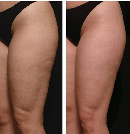 The-left-lateral-thigh-of-a-29-year-old-female-before-treatment-left-and-1-month-after.jpg