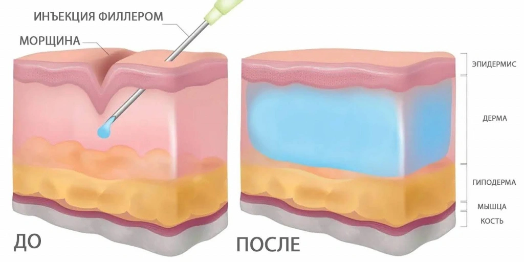 Введение филлера под кожу
